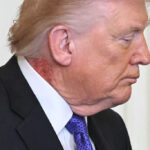 Trump’s Rash: What’s Going On Around His Neck And What Did The White House Say?