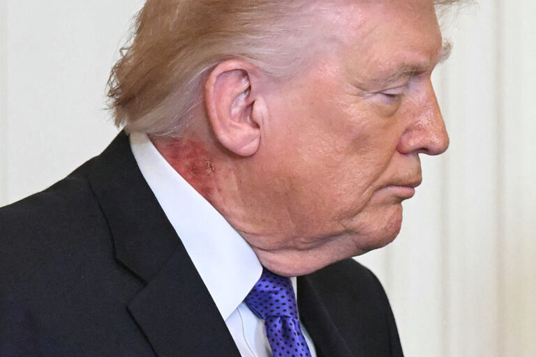 Trump’s Rash: What’s Going On Around His Neck And What Did The White House Say?