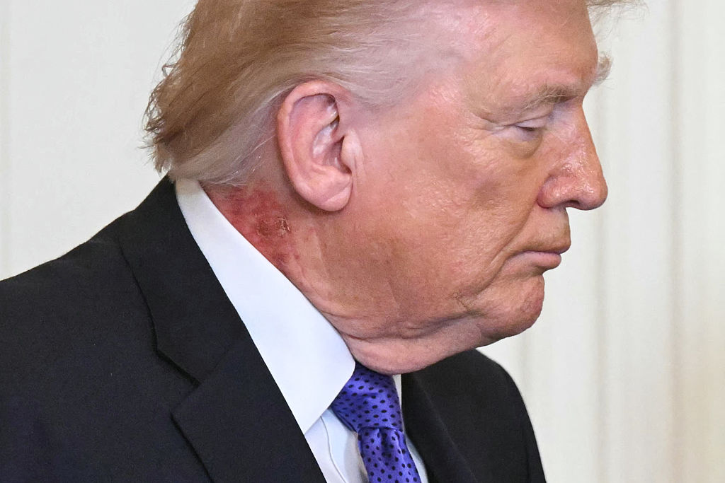 Trump’s Rash: What’s Going On Around His Neck And What Did The White House Say?